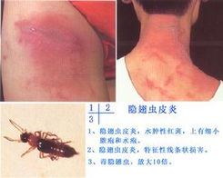 男孩拍打隐翅虫后误用药物导致全身溃烂，警示与反思
