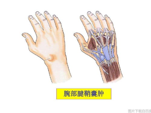 女子腱鞘囊肿看中医挤出凝胶状物，传统医学的神奇疗效与现代医学的解读