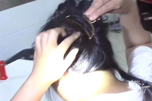 女子头戴鲨鱼夹摔倒后成植物人——一次意外的悲剧