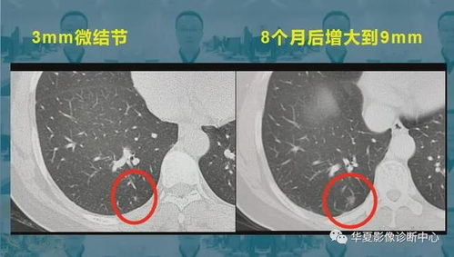 肺癌筛查与肺结节的误区解析