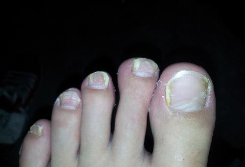 女子频繁美甲引发甲周纤维瘤的增长
