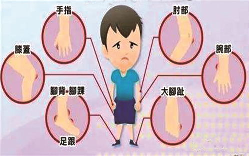 痛风为何盯上年轻人