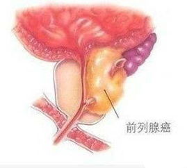 前列腺癌的早期症状
